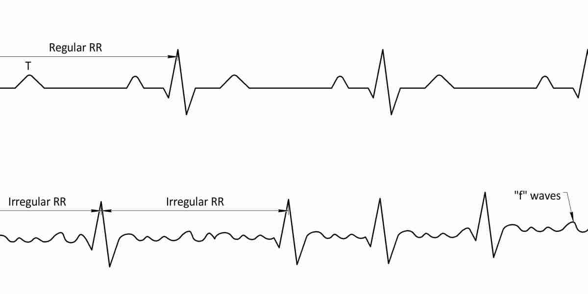 Atrial Fibrillation (Afib) Market: Exploring the Restraints in Affordability and Innovation