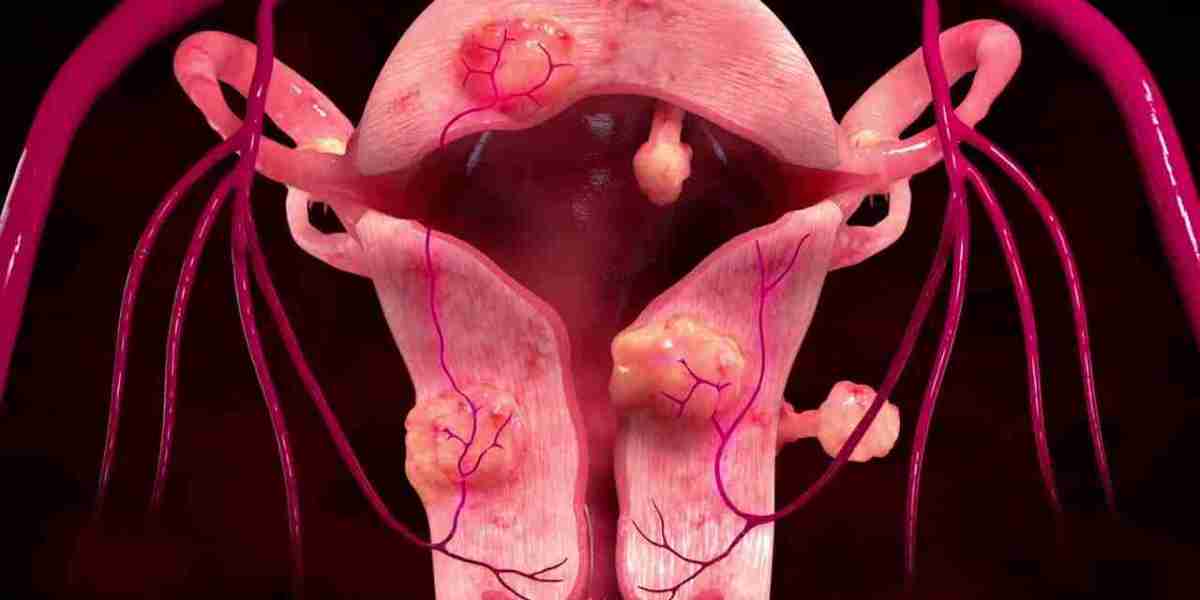 Uterine Fibroid Treatment Market Potential: Examining the Rise of Herbal, Nutritional, and Holistic Approaches to Fibroi