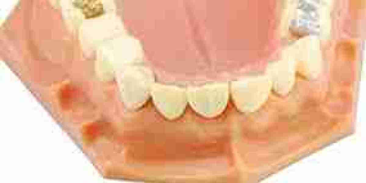 Tooth Filling Materials Market Scope and Insights: Exploring Market Trends, Emerging Challenges, Strategic Opportunities