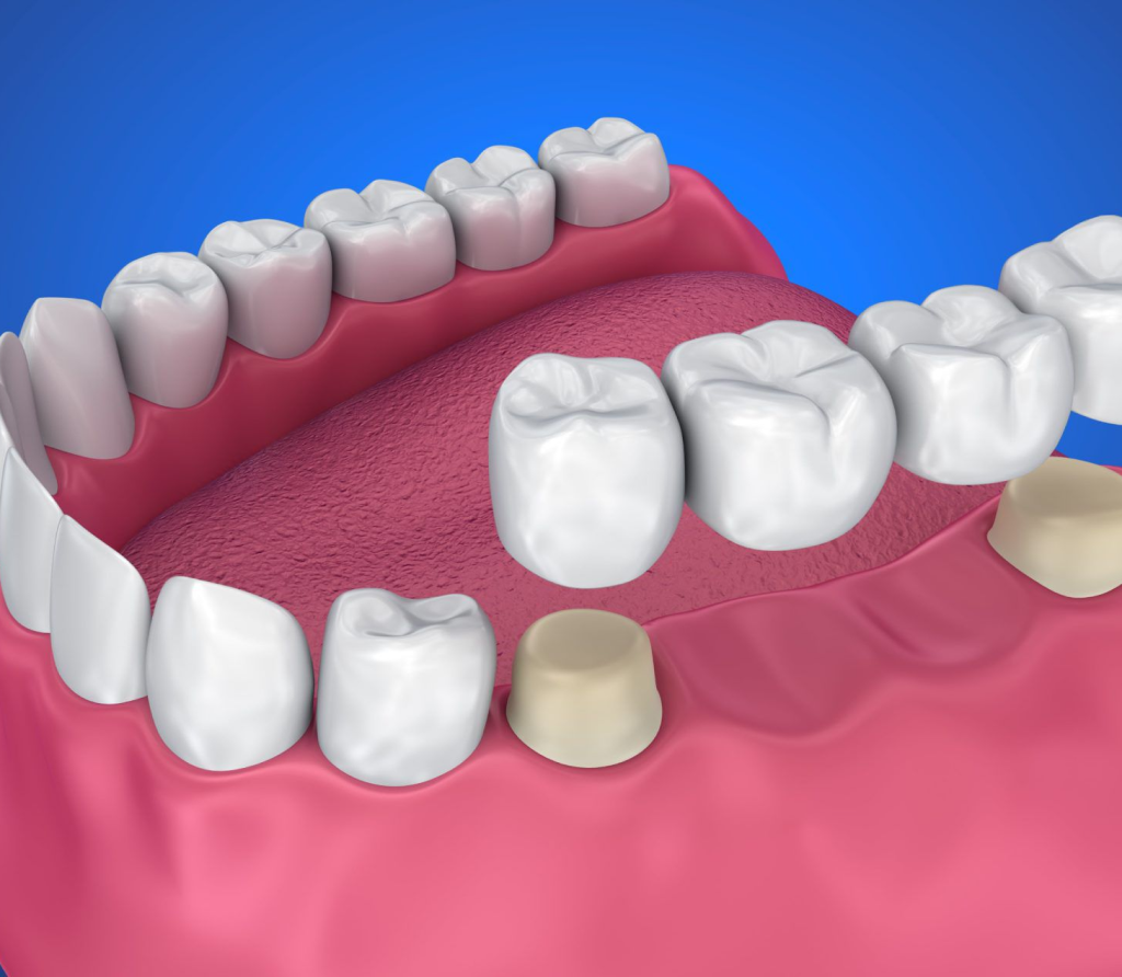 Premier Dental Crowns in Dubai | Dental Bridges in Dubai