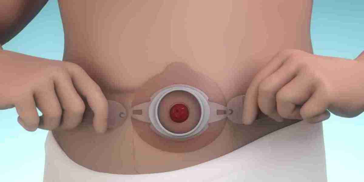 Ostomy Devices Market: Hindrances Impacting Accessibility and Growth