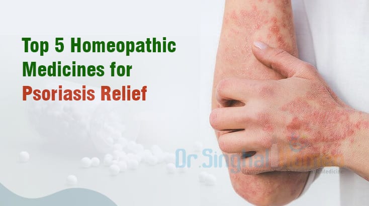 Discover the Top 5 Homeopathic Medicines for Psoriasis