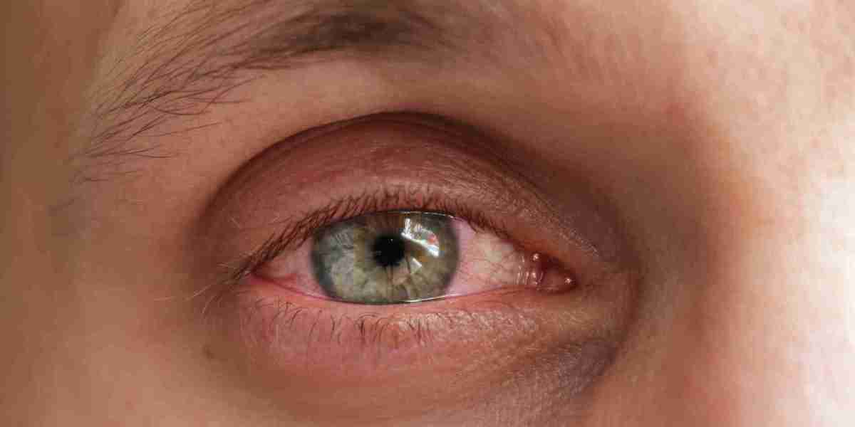 Dry Eye Syndrome Market: Analyzing the Key Dynamics Influencing Market Growth