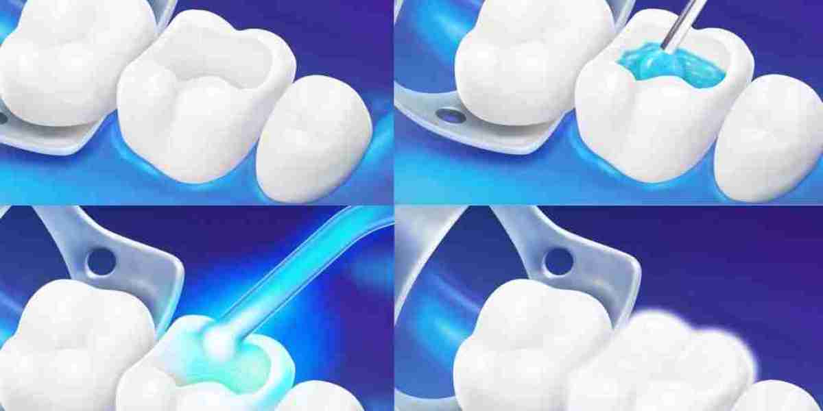 Tooth Filling Materials Market Restraints: Understanding the Key Challenges Hindering Market Expansion