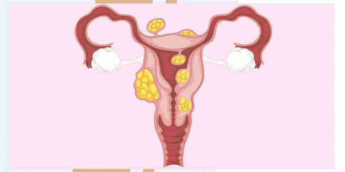 Uterine Fibroid Treatment Market Restraints and Key Challenges: Examining the Obstacles to Market Expansion