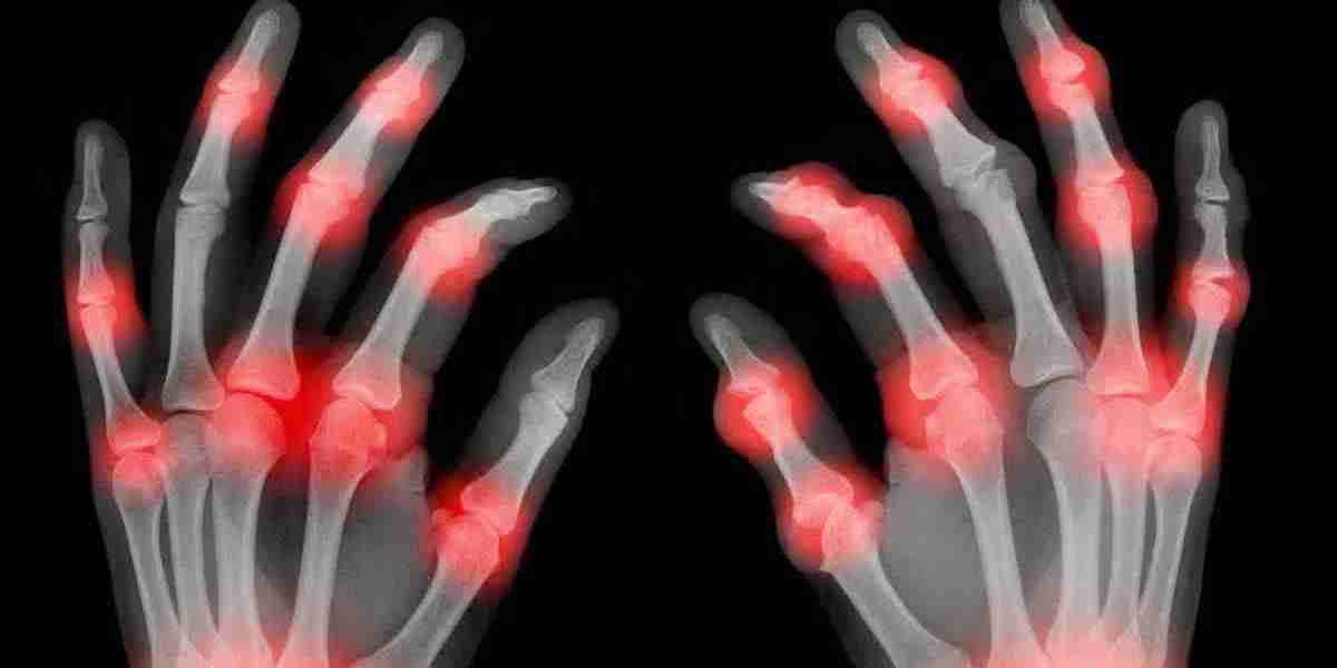 Arthritis Therapeutics Market: Assessing the External Threats to Market Stability