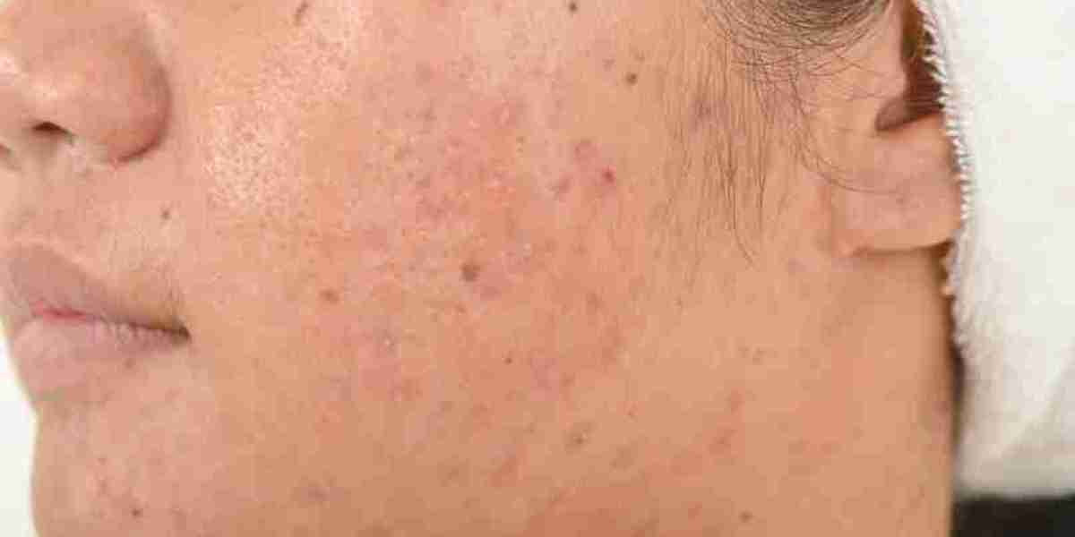 Anti-Acne Dermal Patch Market Distribution Channels and Regional Insights