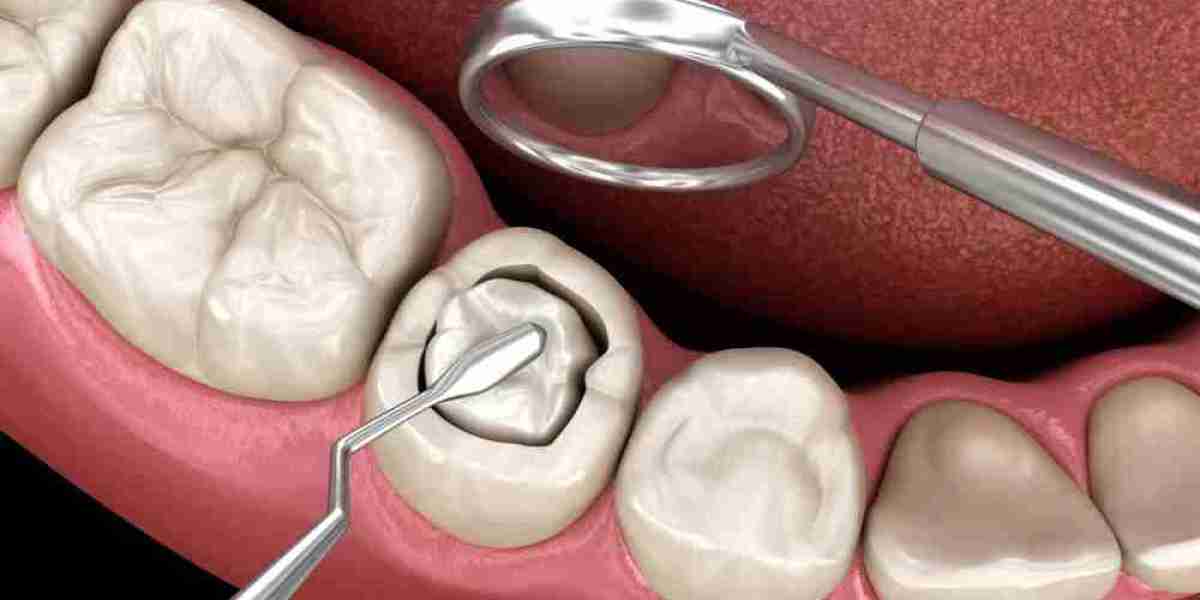 Dental Sealants Market: Addressing the Restraints Affecting Market Expansion