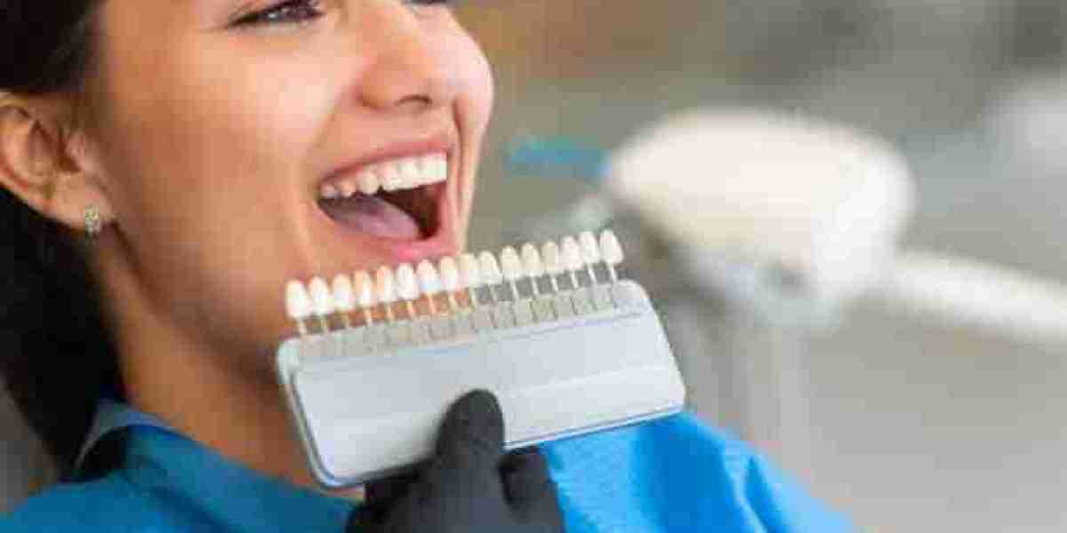 How Long Does Teeth Whitening Last? Riyadh Dentists Explain