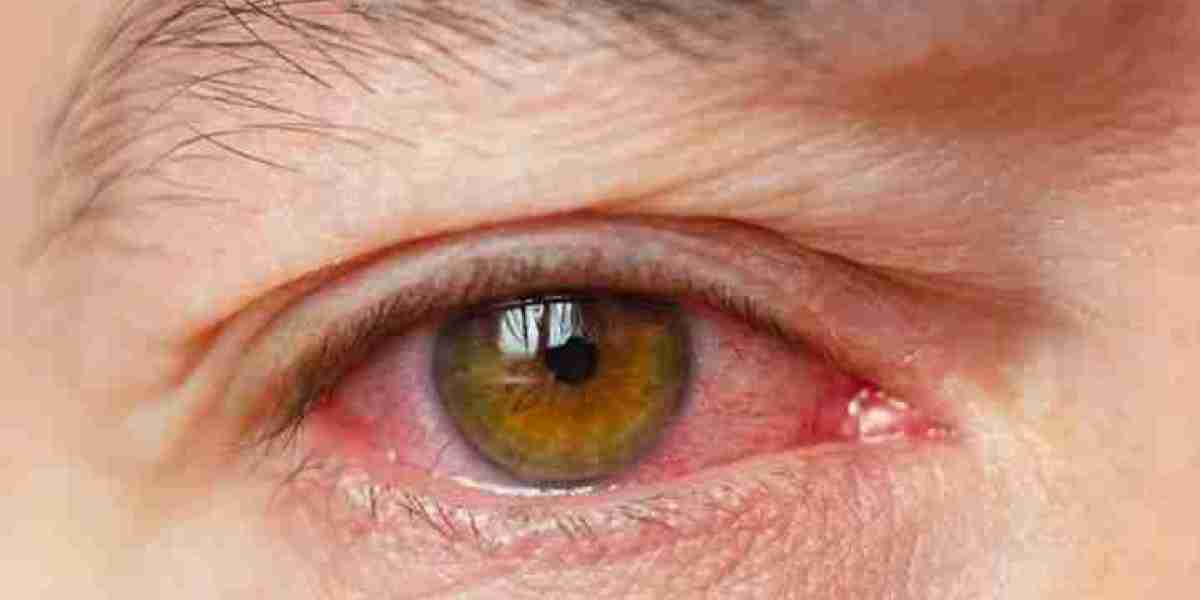 Dry Eye Syndrome Market Threats: The Impact of Limited Awareness, Competition, and High Treatment Costs on Growth