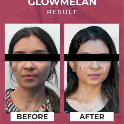 GLOWMELAN - Skin Brightening and Depigmentation Cream Profile Picture