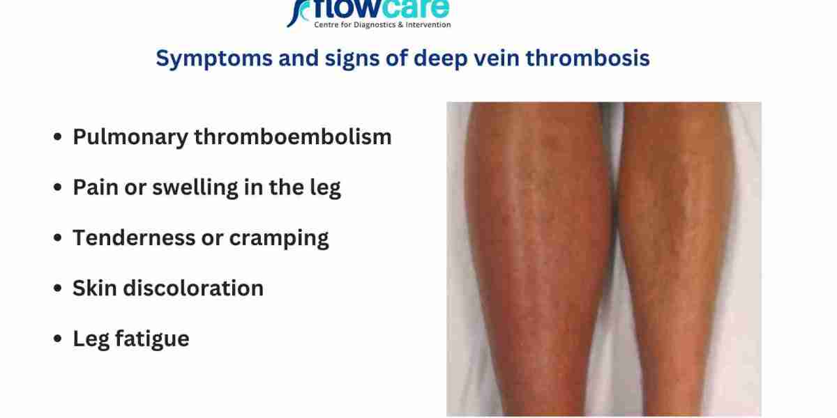 Recognizing Deep Vein Thrombosis Symptoms Early