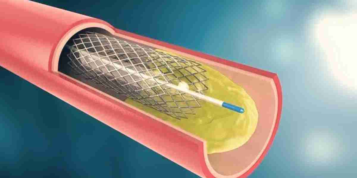 Angioplasty Balloons Market Growth and Technological Advancements Driving Market Expansion