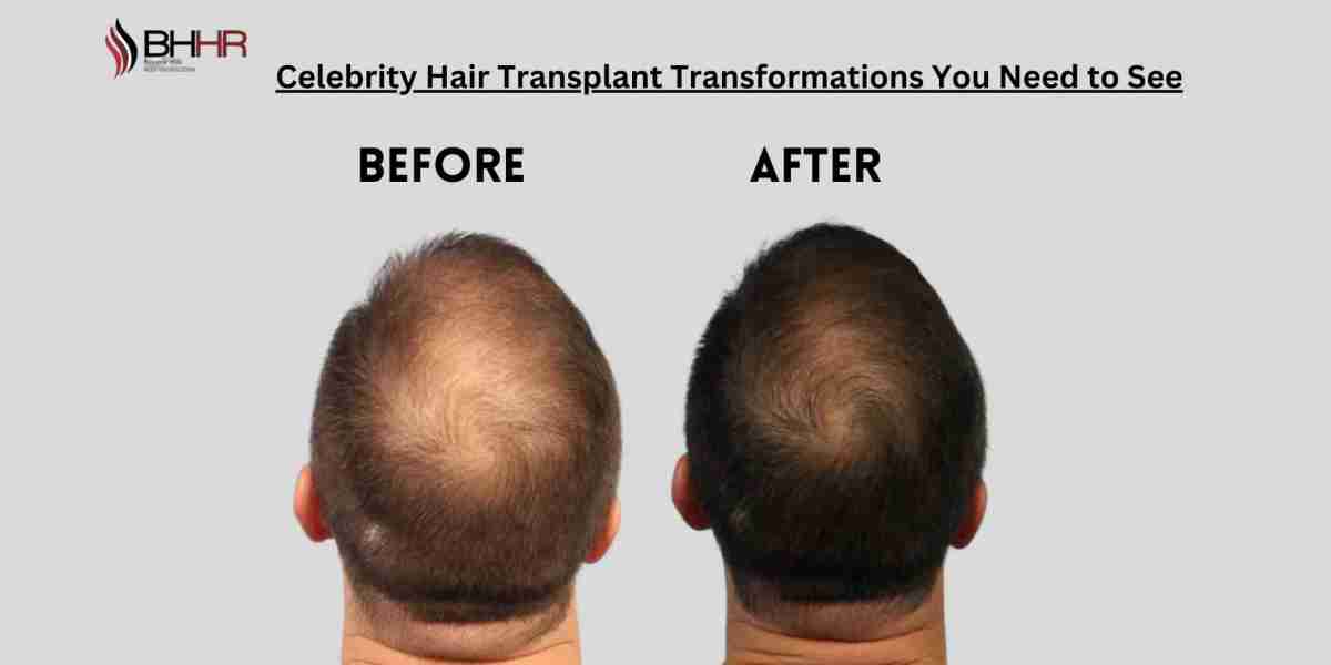 Celebrity Hair Transplant Transformations You Need to See