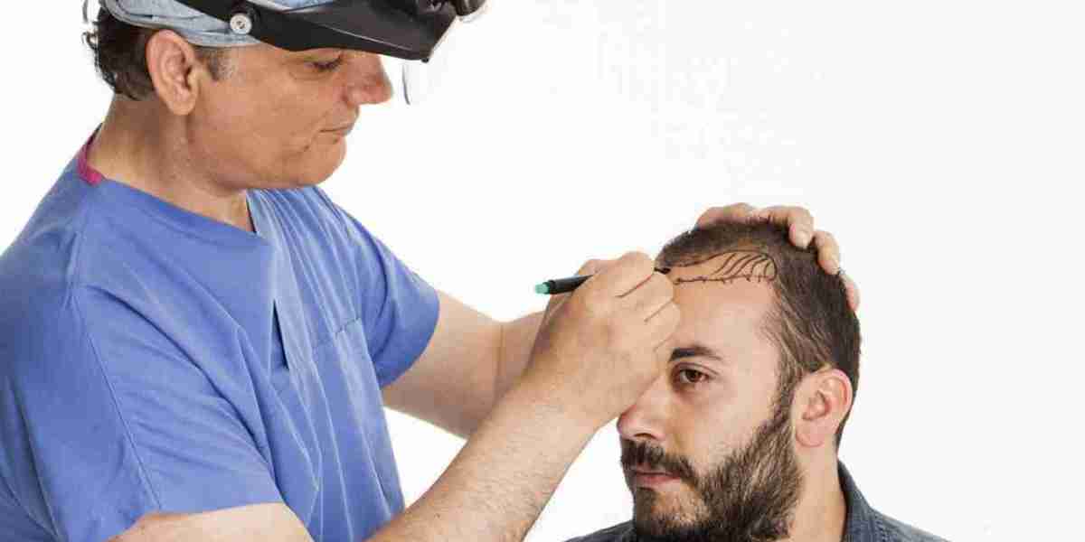 The Science Behind Hair Transplant in Islamabad