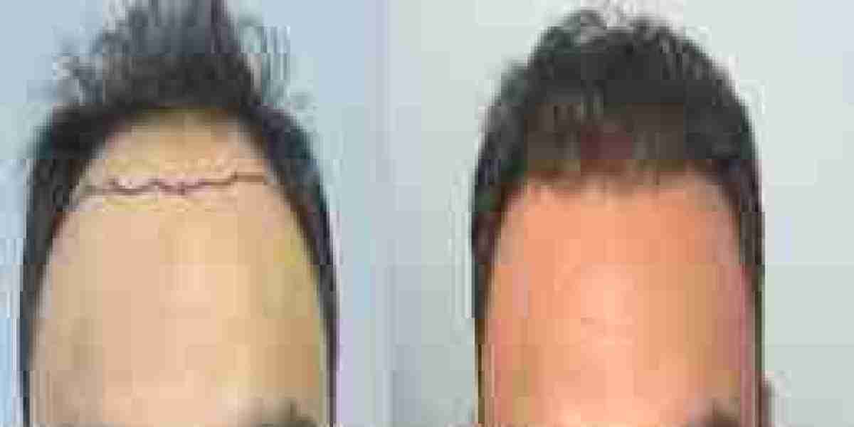 Hair Transplant in Dubai – Cost, Benefits & Procedure