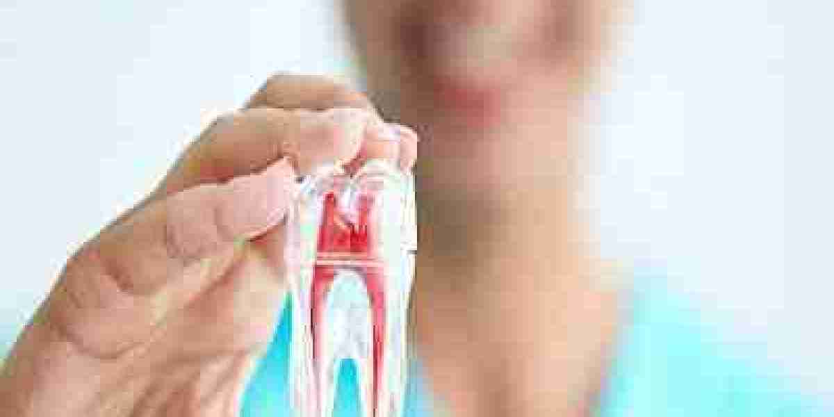 Budget-Friendly Alternatives for Root Canal in Islamabad