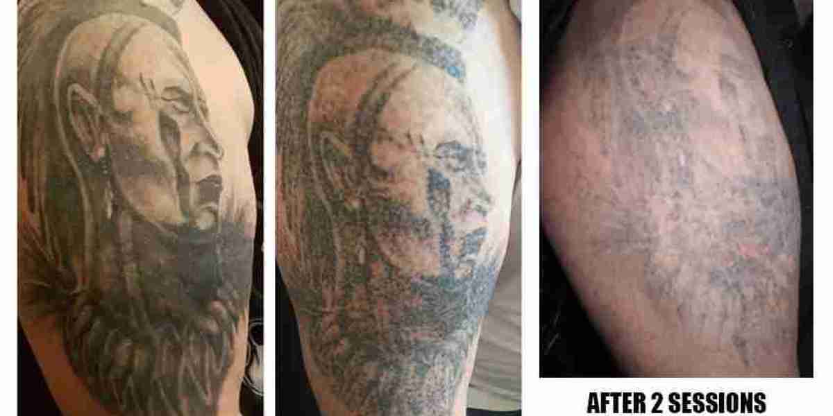 Ink Regrets The Advantages of Laser Tattoo Removal in London