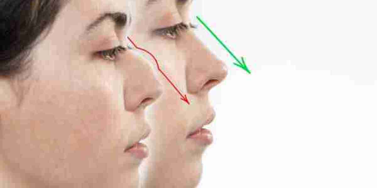 Everything About Rhinoplasty Surgery in Riyadh for a Stunning Look