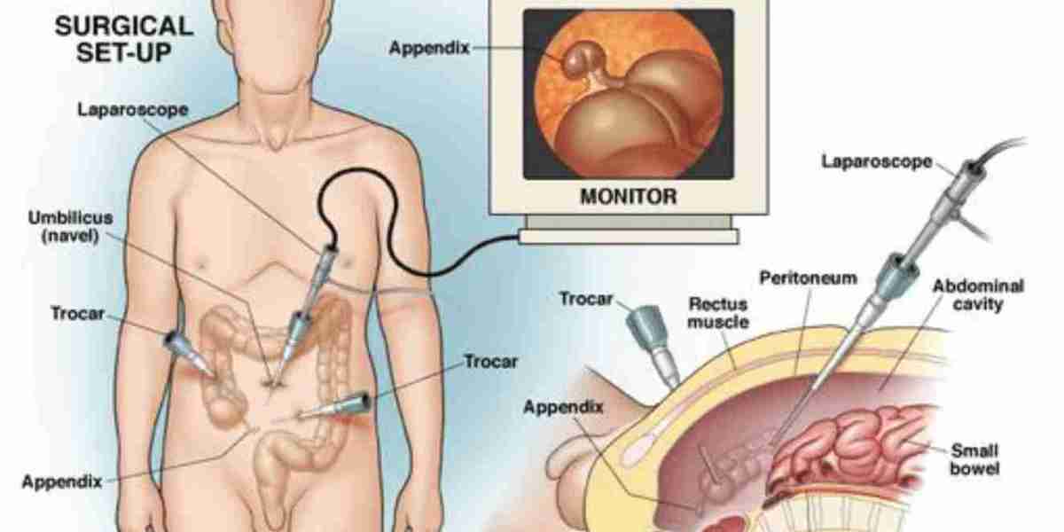 Laparoscopic Surgery in Riyadh: Myths vs. Facts