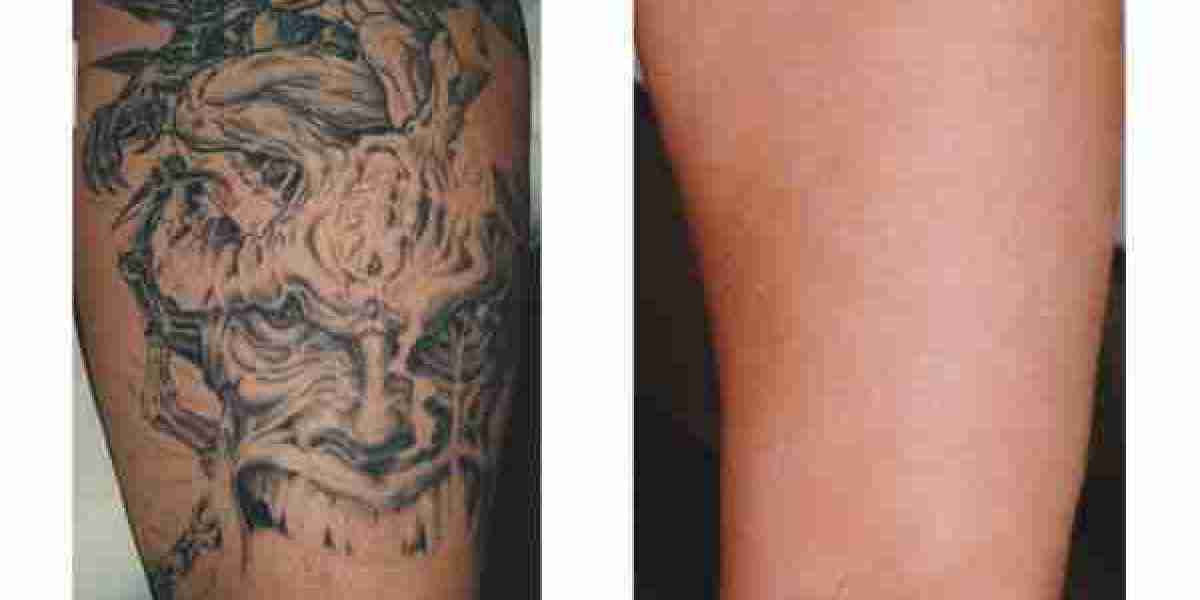 Proven Tattoo Removal You Can Trust in Dubai