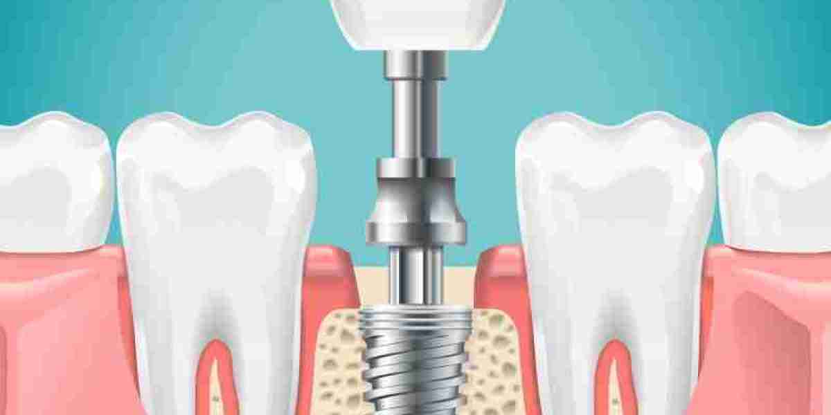 Dental Implants for Seniors, Is It Too Late?