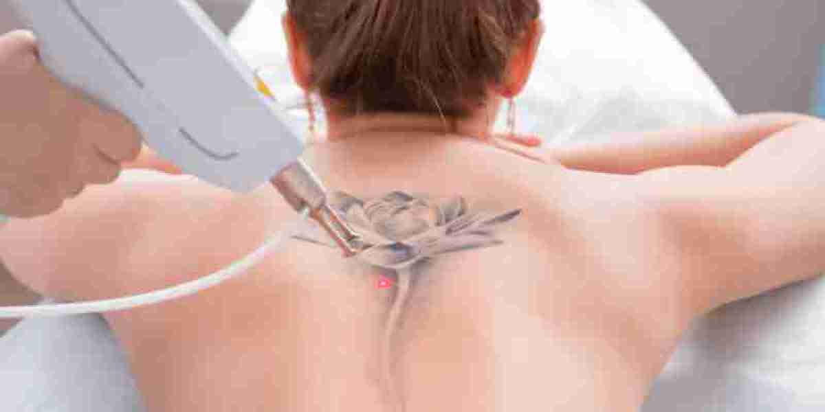 Are Black Tattoos Easier to Remove?