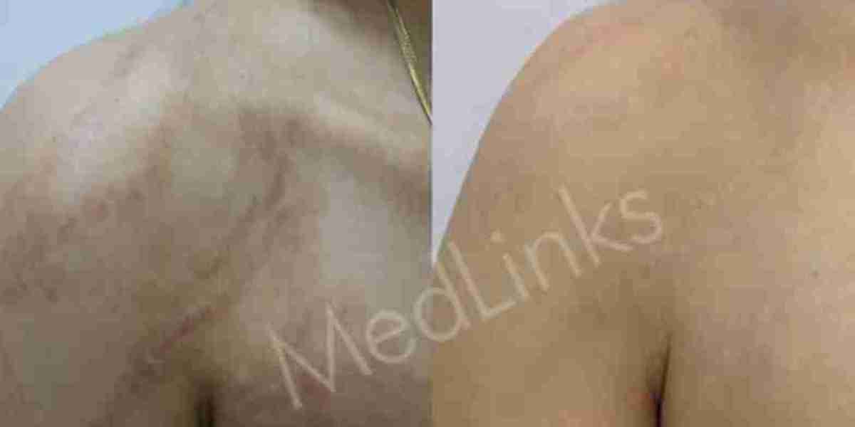 Achieve Clearer Skin with Expert Acne Scar Treatment in Delhi at Medlinks