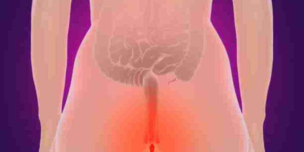Why Choose Laser Treatment for Hemorrhoids in Riyadh?