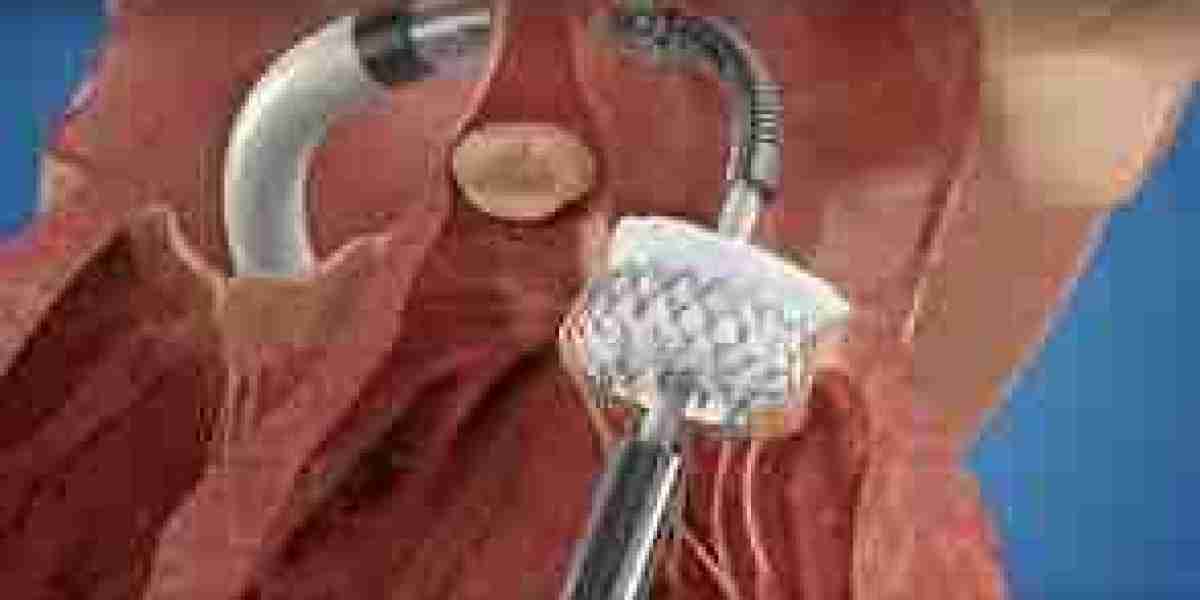 Heart Valve Devices Market Growth: Trends, Drivers, and Future Outlook