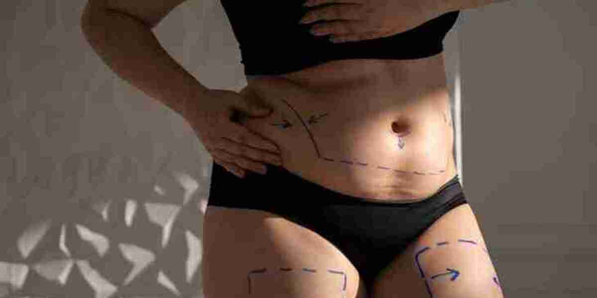 Can Liposuction Fix a Double Chin?