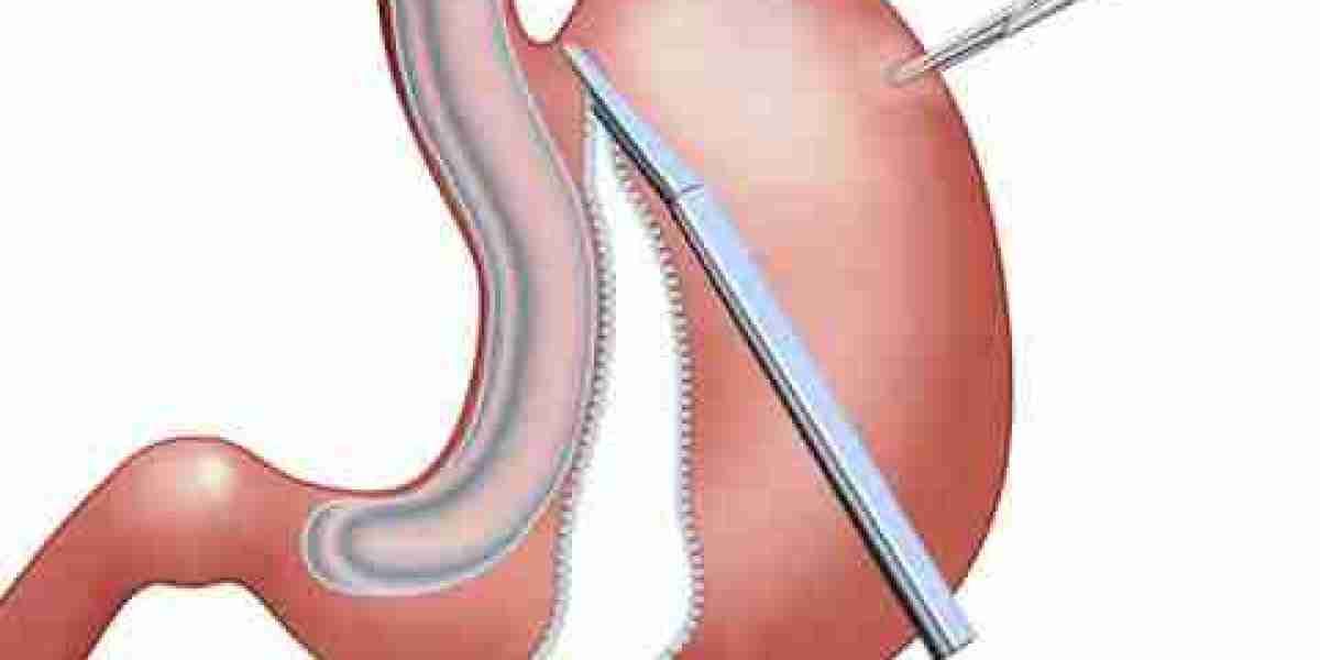 The Truth About Gastric Sleeve Surgery in Riyadh