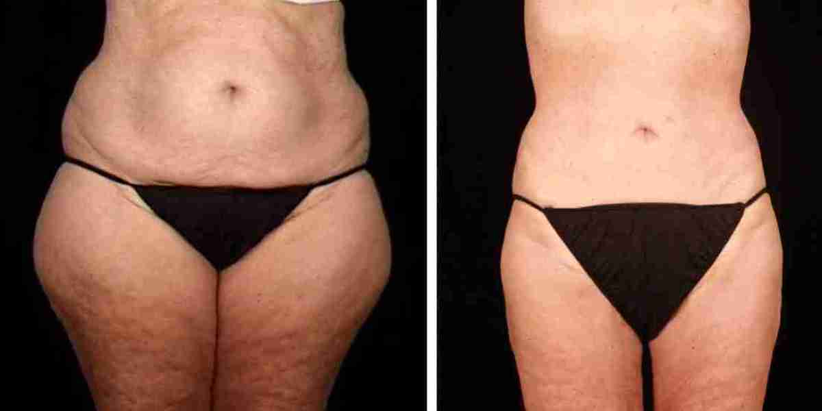 Target Stubborn Fat with Precision in Dubai