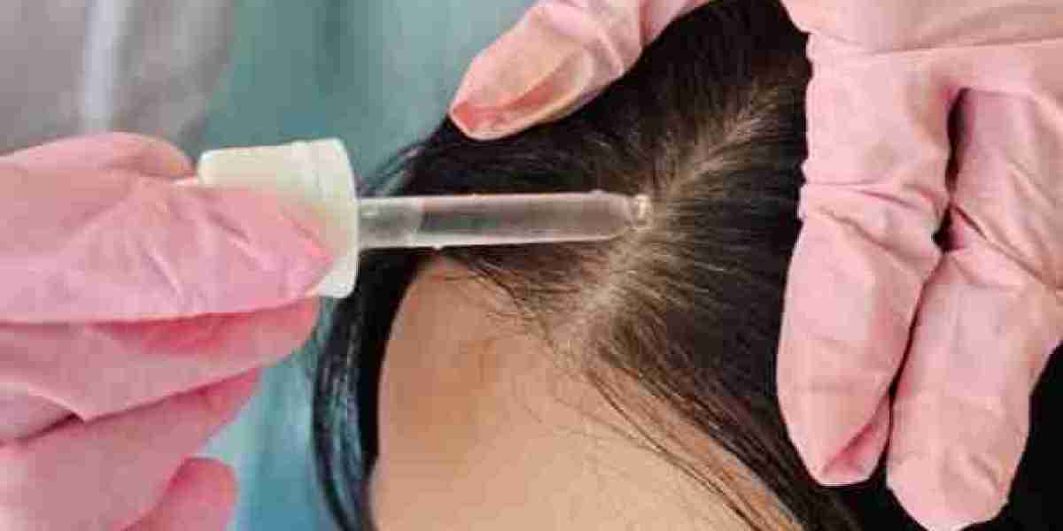 Discover the Science Behind Exosomes Therapy for Hair Loss in Riyadh