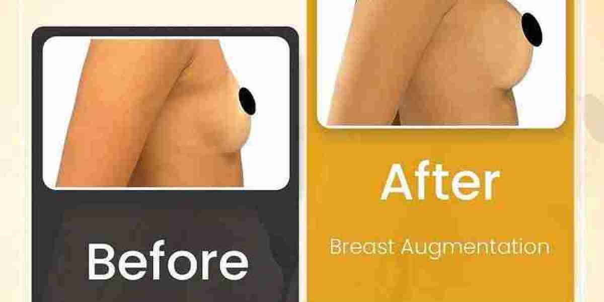 Transform Your Confidence with Breast Augmentation Surgery in Dubai