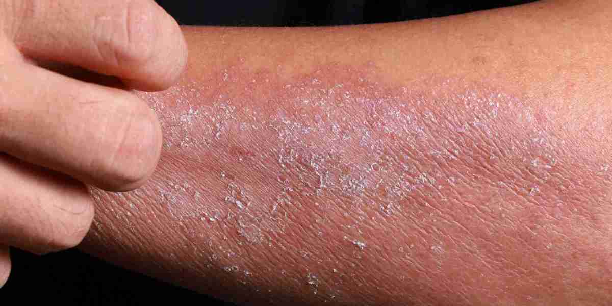 Atopic Dermatitis Market Witnesses Surge in Consumer Preference for Natural Remedies and Clean-Label Therapeutic Alterna