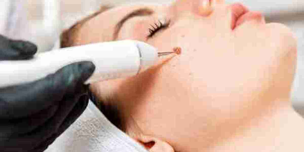 Upgrade Your Skin Routine: Laser Wart Removal in Dubai