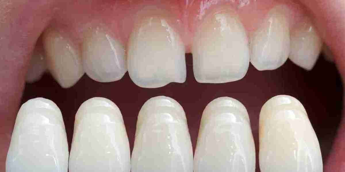 The Cost of Dental Veneers: Your Key to a Beautiful Smile