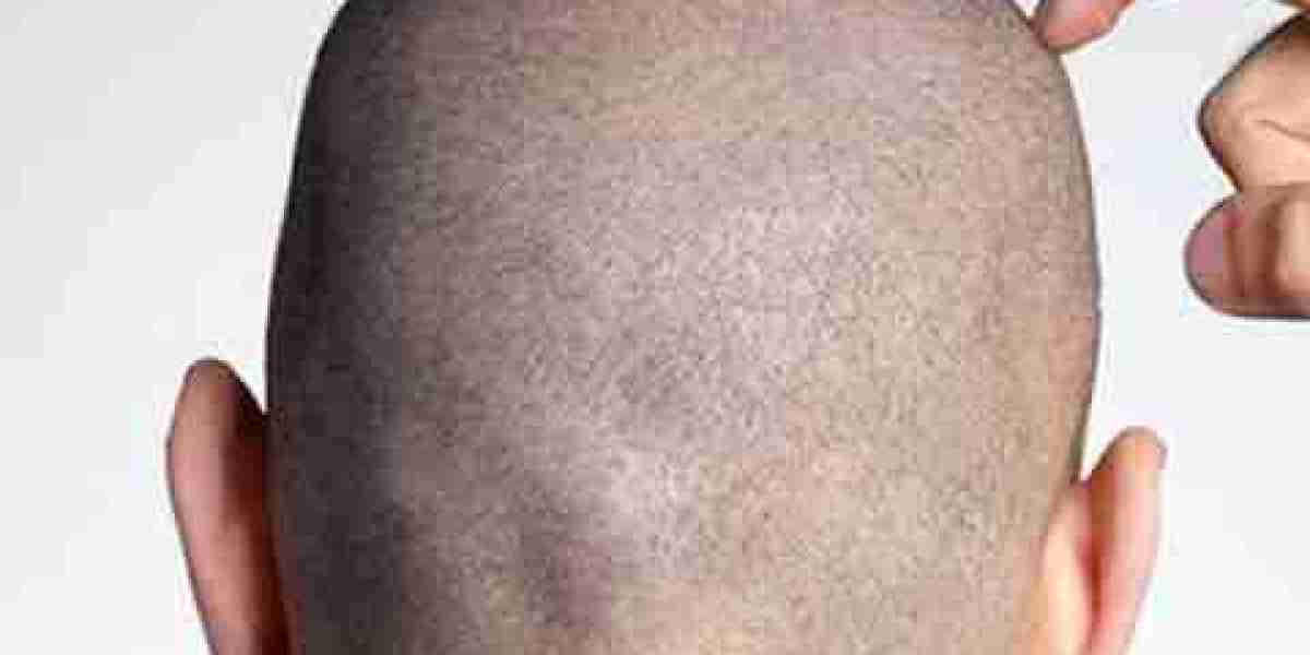 زراعة الشعر في دبي: طرق مبتكرة وشروط لاختيار الطبيب المثالي