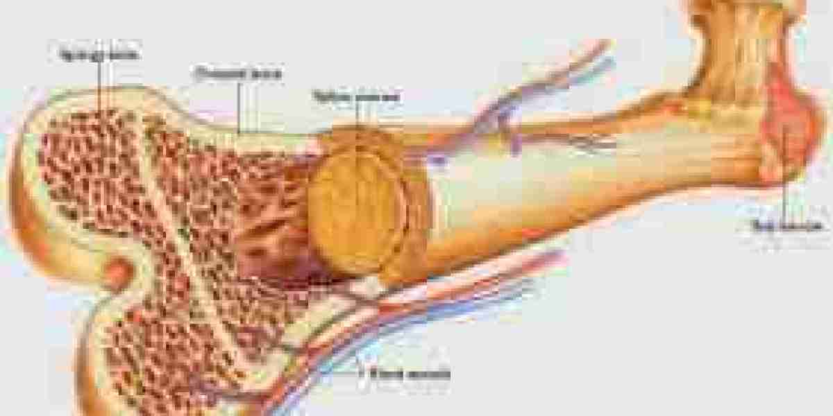 Understanding Bone Cancer Treatment Costs in India with Cross Border Care