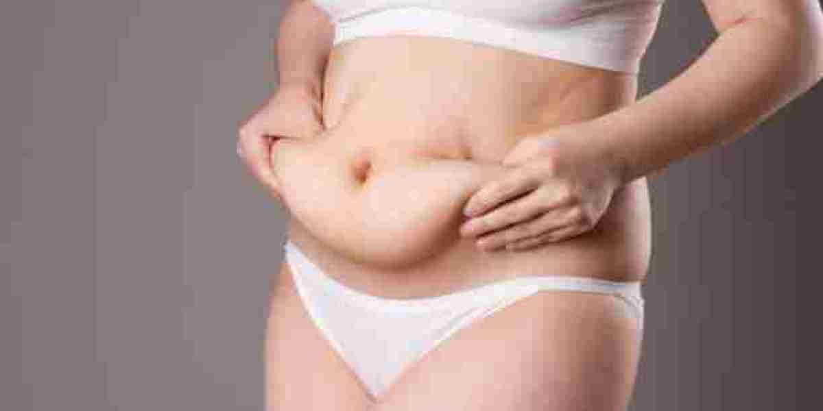 Real Results from a Tummy Tuck in Riyadh