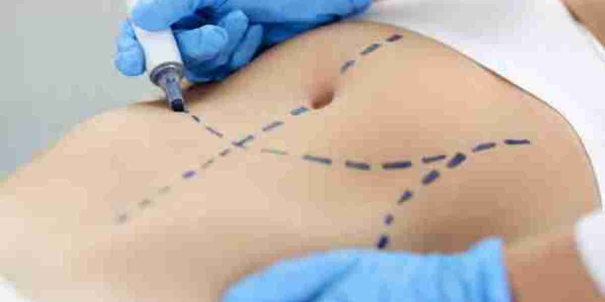 What to Expect from Tummy Tuck in Riyadh