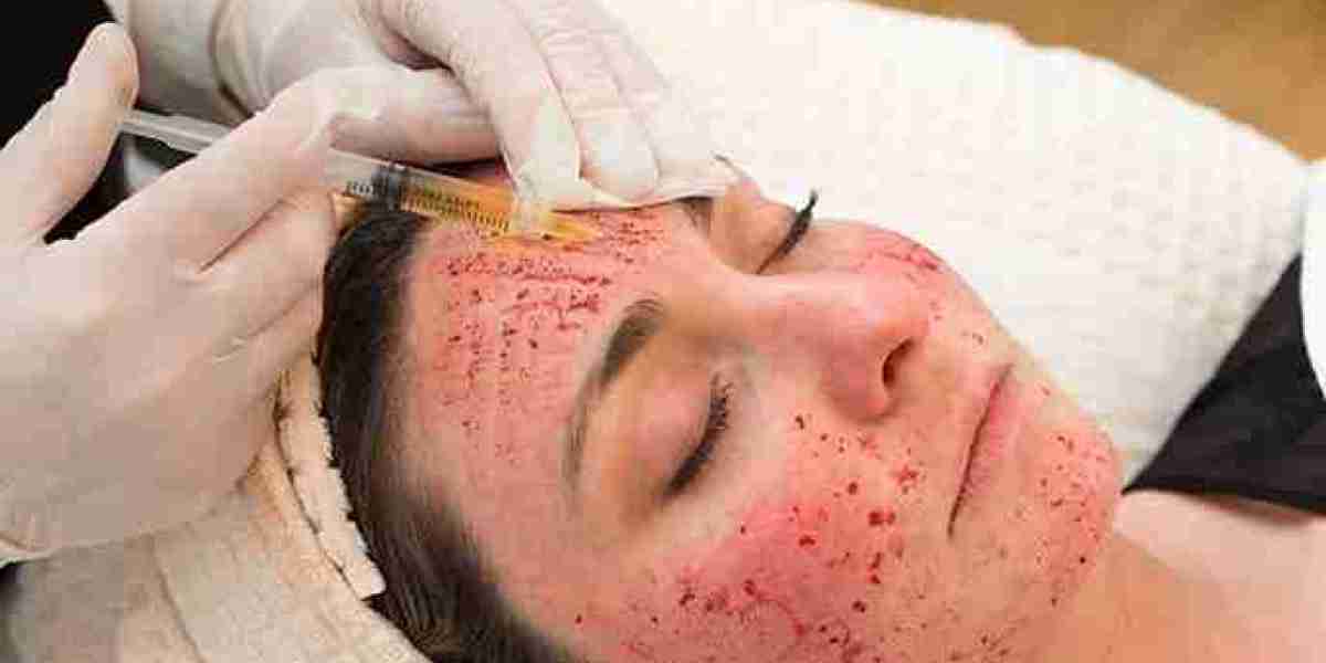 Are Vampire Facials Suitable for Men?