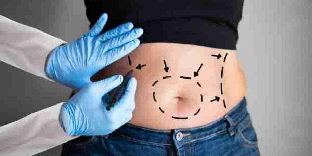 2025 Guide to Tummy Tuck in Riyadh: What to Expect