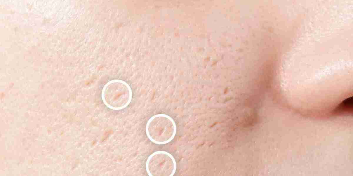 Acne Treatment With LED Light Therapy Explained