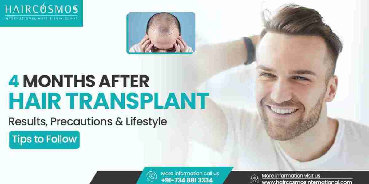4 Months After Hair Transplant: What to Expect | Hair Cosmos International
