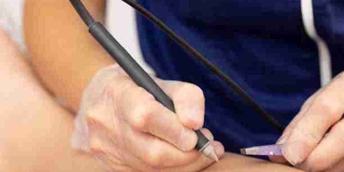 Riyadh Electrolysis Surgery for Men’s Grooming