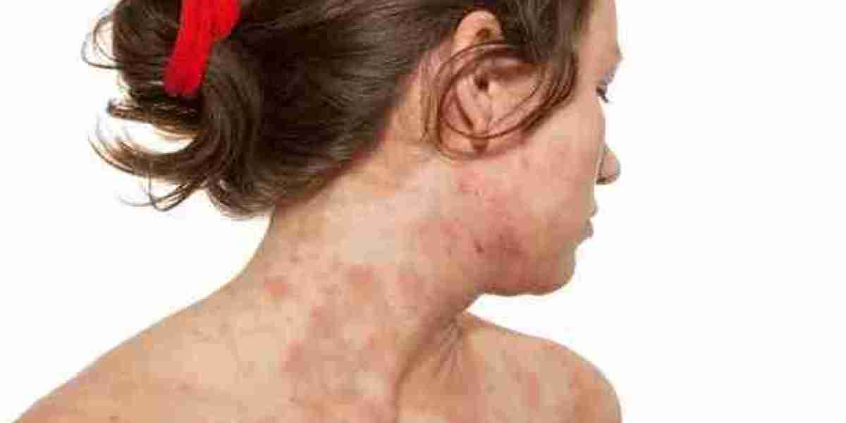 What Triggers Hives and Welts?