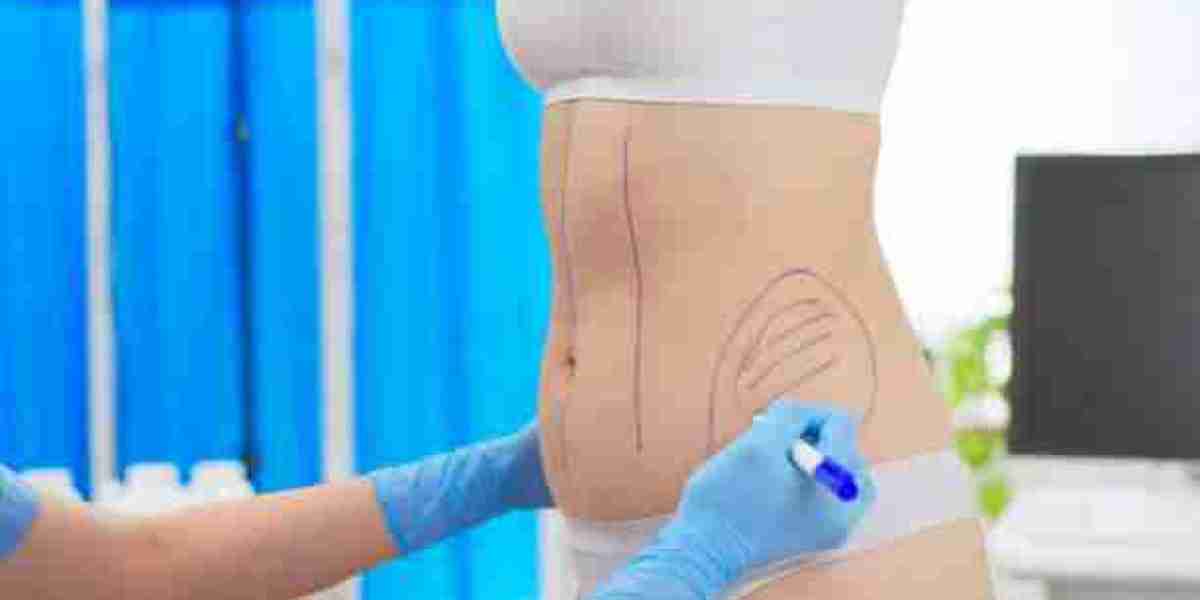 Liposuction in Riyadh: Quick Recovery Tips