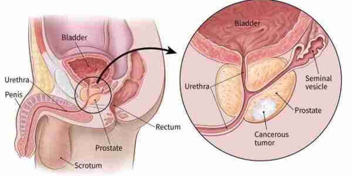 Prostate Cancer Treatment Cost in India